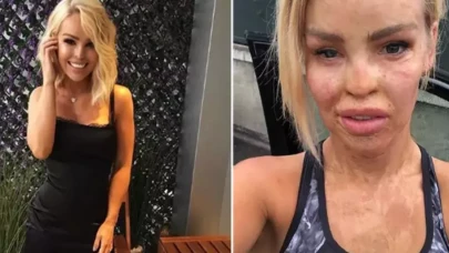 Katie Piper’ın  Süren Mücadelesi